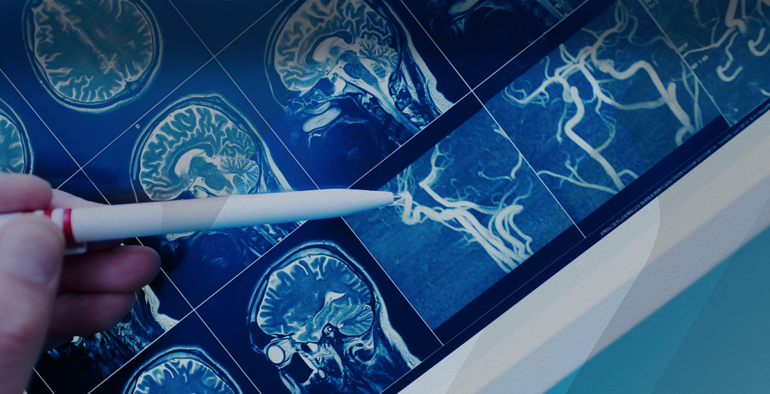 Accompagner les patients épileptiques : recommandations pour la conduite