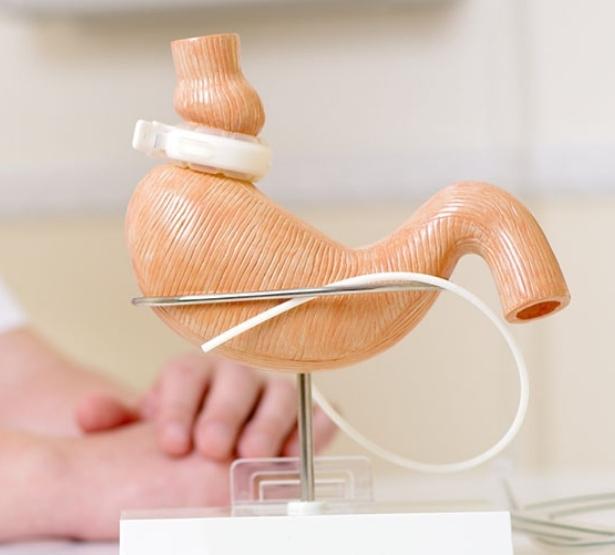 Ablation des anneaux de gastroplastie MACSF