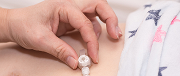 Soins d'une sonde de gastrostomie - MACSF