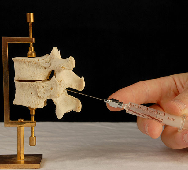 Les injections intradiscales de corticostéroïdes - MACSF