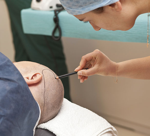 Préparation du patient avant greffe de cheveux | MACSF