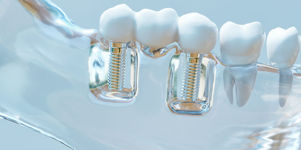 Responsabilité en implantologie dentaire